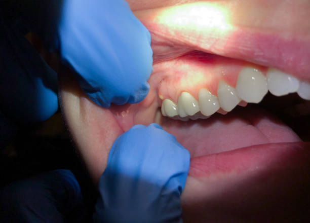Best Knocked-Out Tooth Emergency  in Kapn, LA
