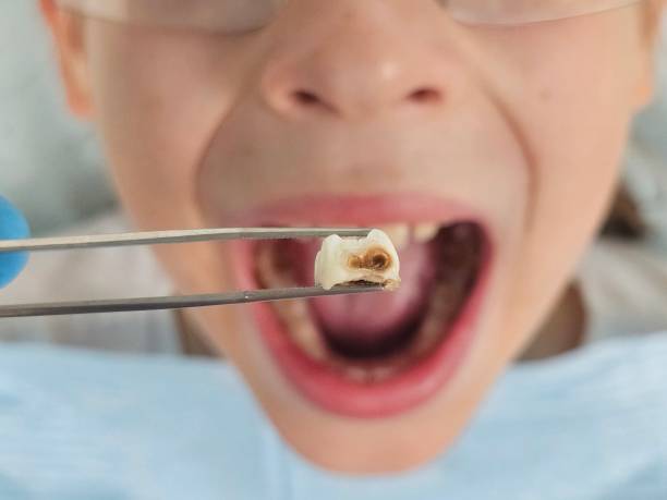 Best Broken Tooth Emergency  in Kapn, LA
